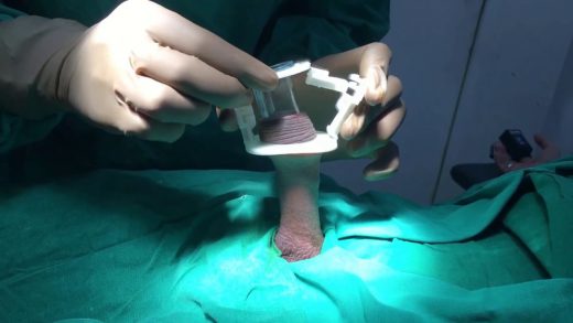 Circumcision Newborn